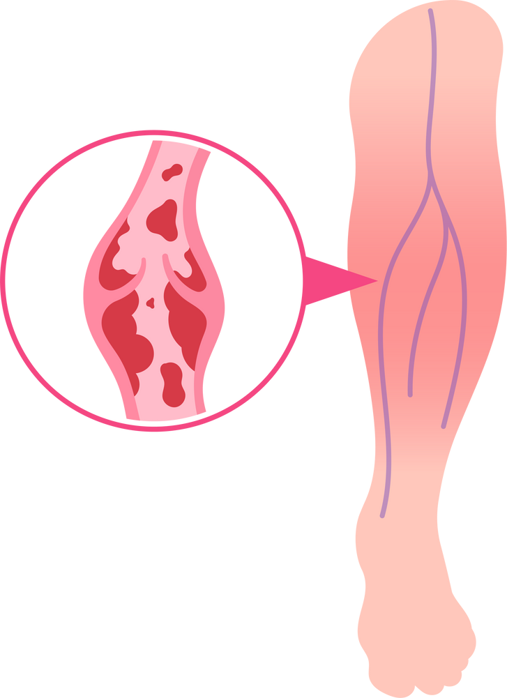 thrombus atherosclerosis thromboembolism coagulation venous insufficiency peripheral vascular disease telangiectasia varicose veins spider thrombophlebitis blood clot deep leg thrombosis embolism vessel