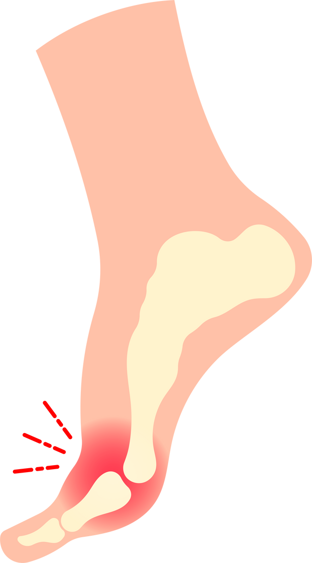 metatarsalgia plantar fasciitis Morton fracture sesamoiditis neuropathy arthritis feet metatarsus flatfoot painful intermetatarsal neuroma bone pain Flatfeet nerve foot bunion metatarsal flat injury toe high heel