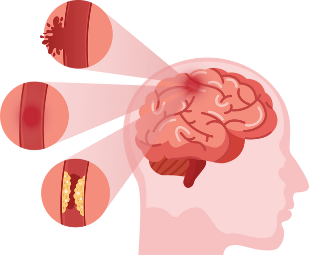 Stroke disease. Hemorrhagic brain stroke concept. Apoplexy,